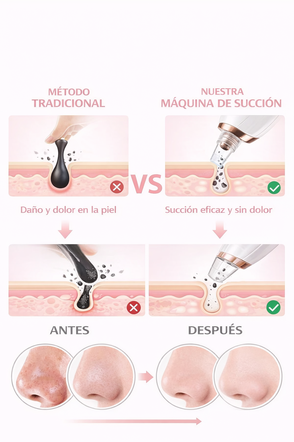 Limpiador de Poros 5 Niveles: Elimina Puntos Negros al Instante