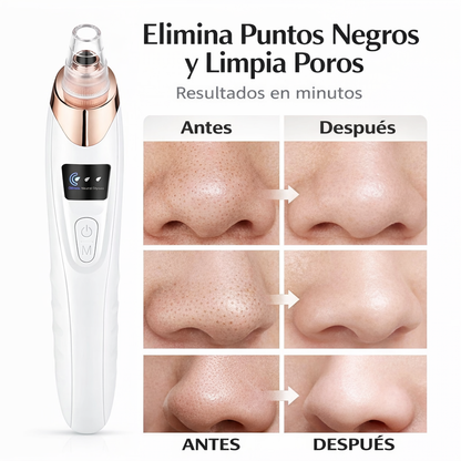 Limpiador de Poros 5 Niveles: Elimina Puntos Negros al Instante